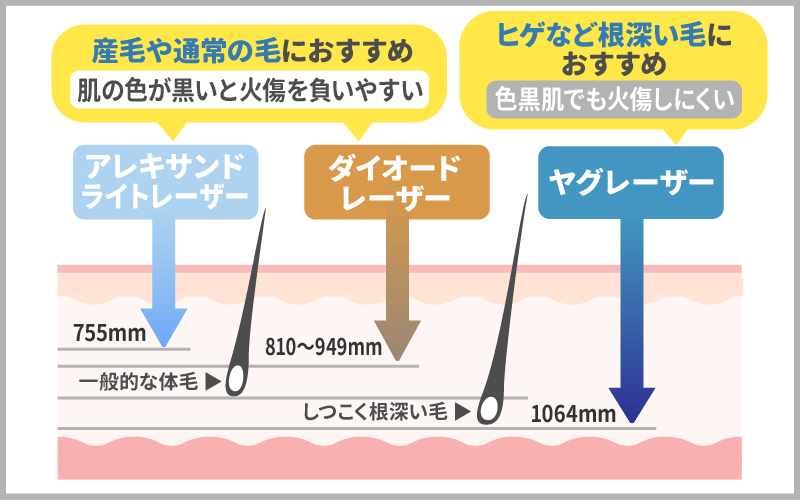 顔の医療脱毛におすすめのレーザーー