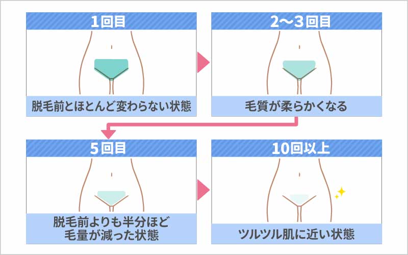 VIO脱毛の経過