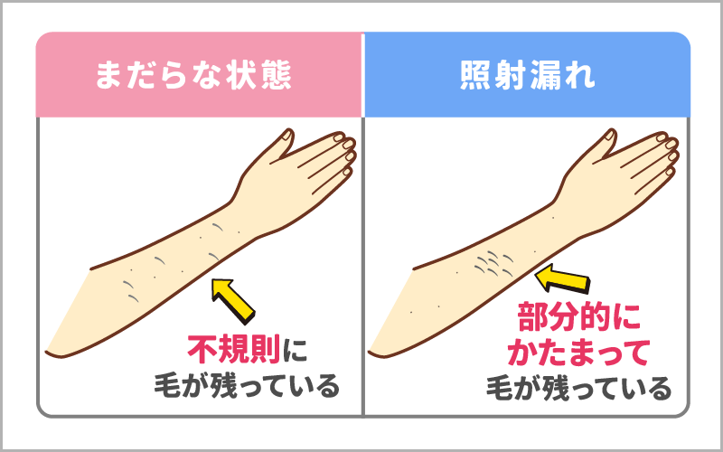 まだらな状態と照射漏れの違い